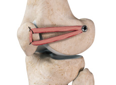 Patello-femoral Replacement