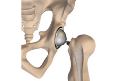 Total Hip Replacement